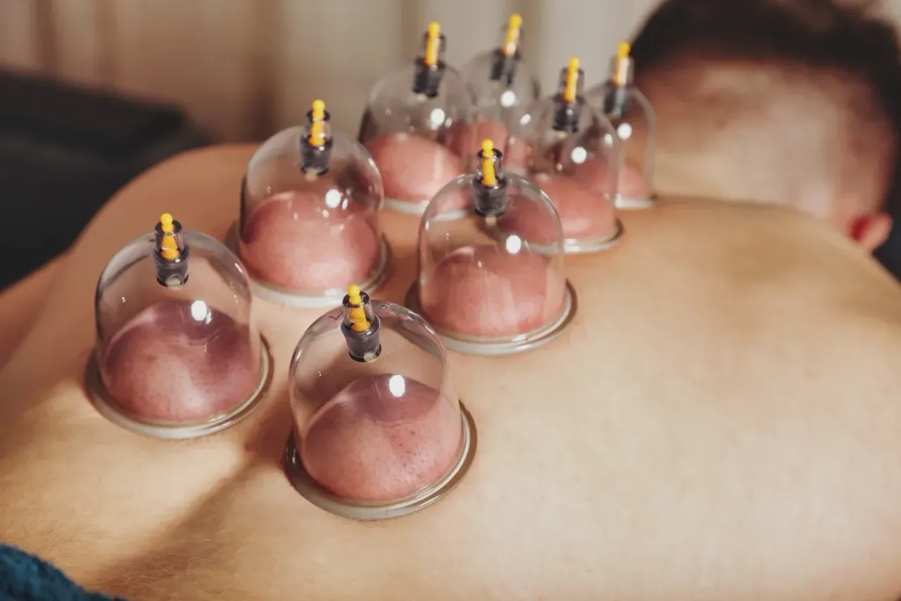 Ventouses sèches posées le long du dos lors d’une séance de massage sportif