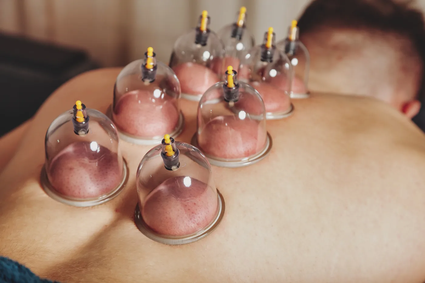 Massage aux ventouses cupping dans un cabinet à Cannes